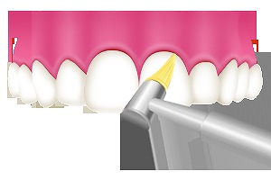 ブラシの届きにくい、歯間をツルツルに磨きます。