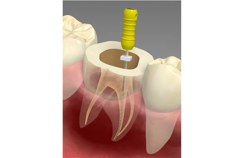 根管治療
