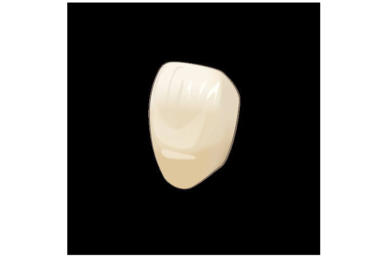 ハイブリッドセラミック(インレー)